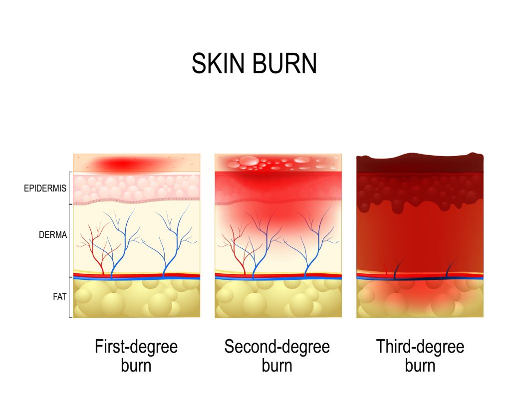 Too hot to handle. This is the 3 degrees of burns.