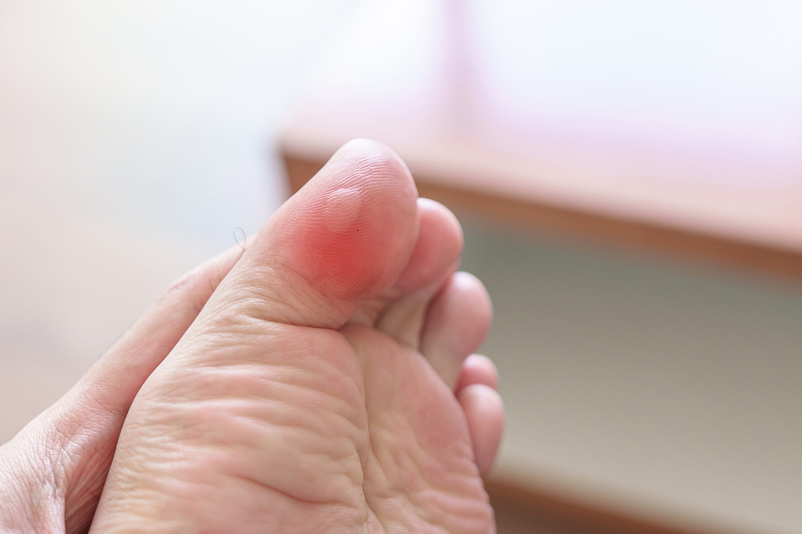 Understanding Blister on toe