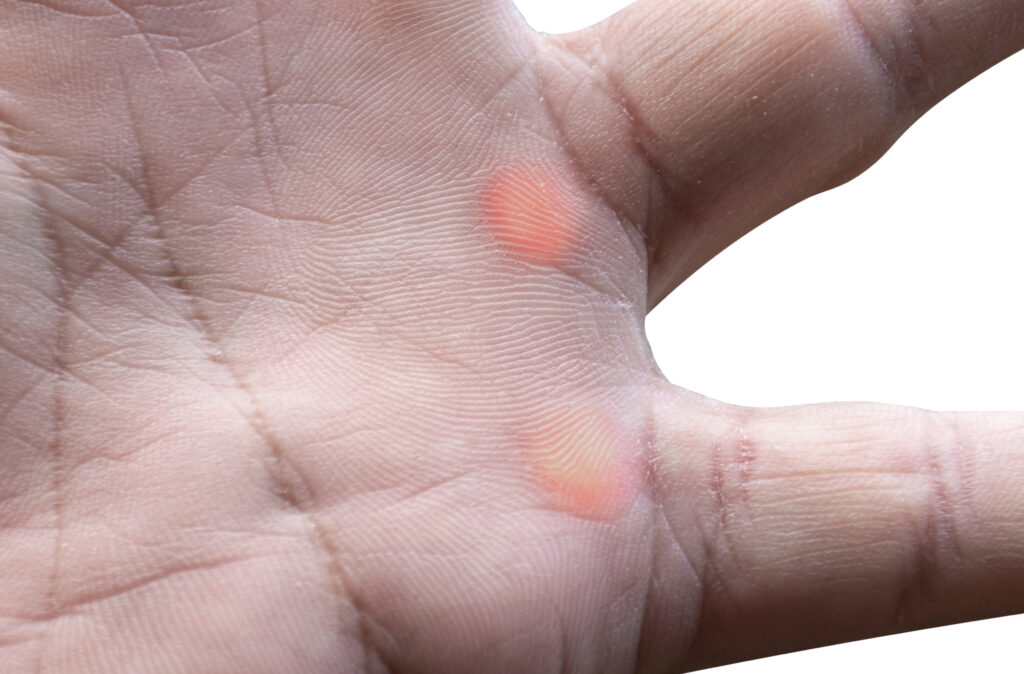 understanding blisters on hand